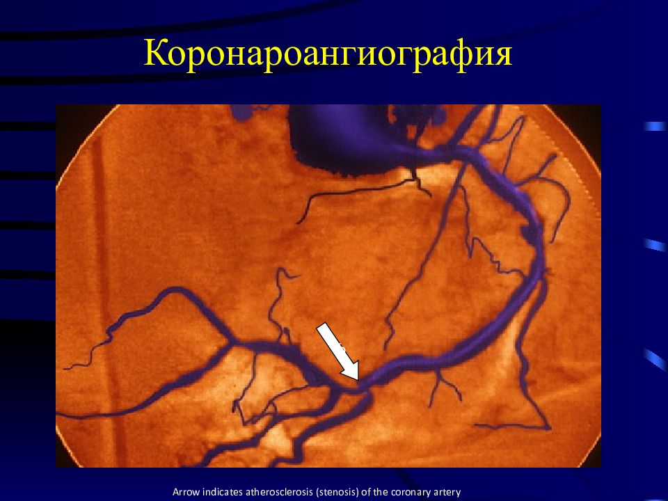 Атеросклероз коронарных артерий. Селективная коронароангиография. Стенозирующий атеросклероз венечной артерии. Методы исследования атеросклероза коронарных артерий. Атеросклероз коронарных артерий на кт.