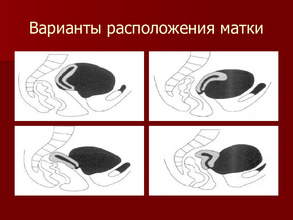 Расположение матки. Типы расположения матки. Варианты положения матки в полости малого таза. Матка расположение срединное. Варианты расположения матки в полости таза.