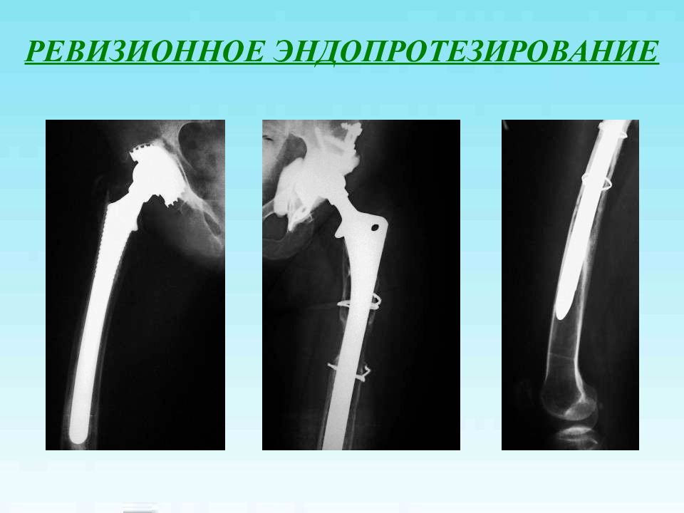 Перелом бедренной кости клинические рекомендации тесты нмо. Перелом шейки бедра остеосинтез. Остеосинтез проксимального отдела бедра рентген. Остеосинтез проксимального отдела бедренной кости. Остеосинтез проксимального отдела бедра.