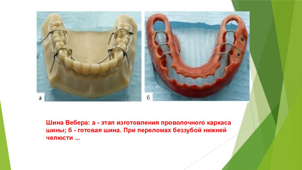 Шинирование челюсти схема при переломе нижней челюсти