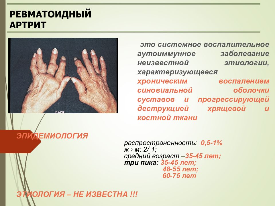 Ревматизм что это. Ревматоидный артрит полиартрит клиника. Ревматоидный артрит субфебрилитет. Ревматический артрит и ревматоидный артрит. Этология ревматоидный артрит.