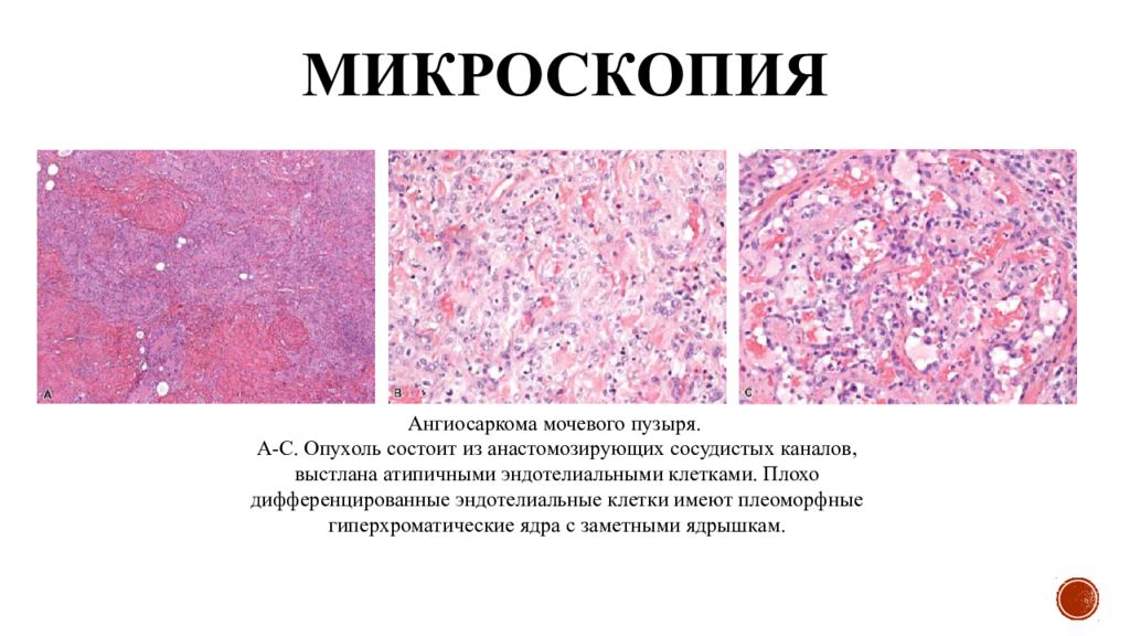 Мезенхимальные опухоли. Опухоли мочевого пузыря микропрепарат.