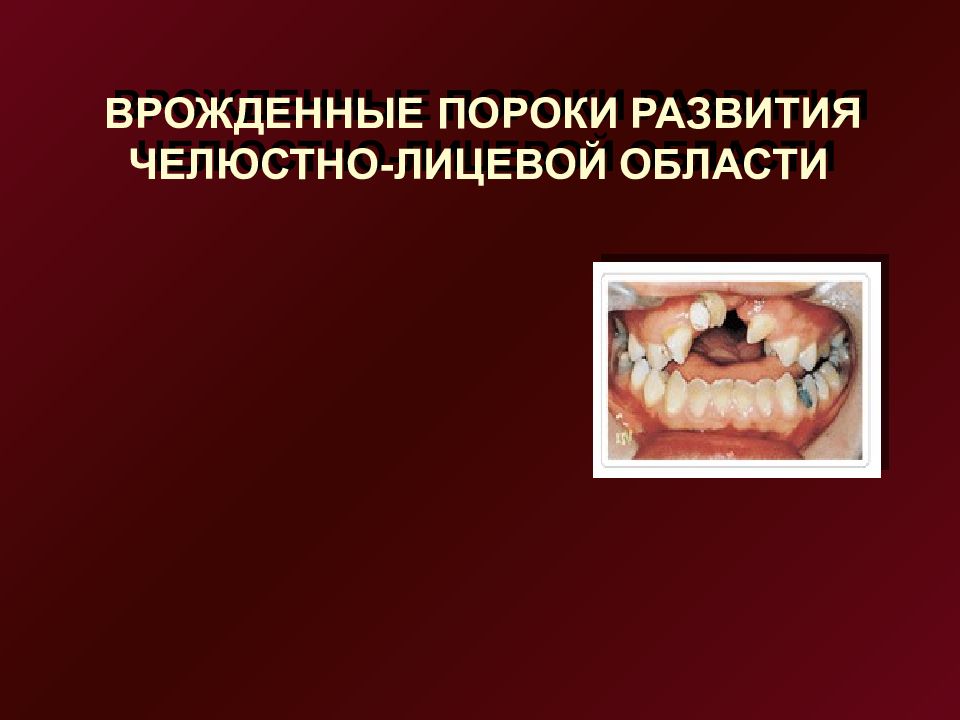ВРОЖДЕННЫЕ ПОРОКИ РАЗВИТИЯ ЧЕЛЮСТНО-ЛИЦЕВОЙ ОБЛАСТИ