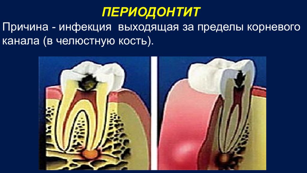 Периодонтит детская стоматология презентация