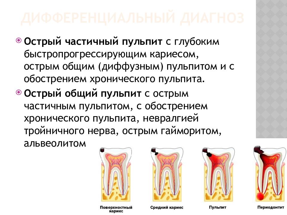 Острый диффузный пульпит презентация