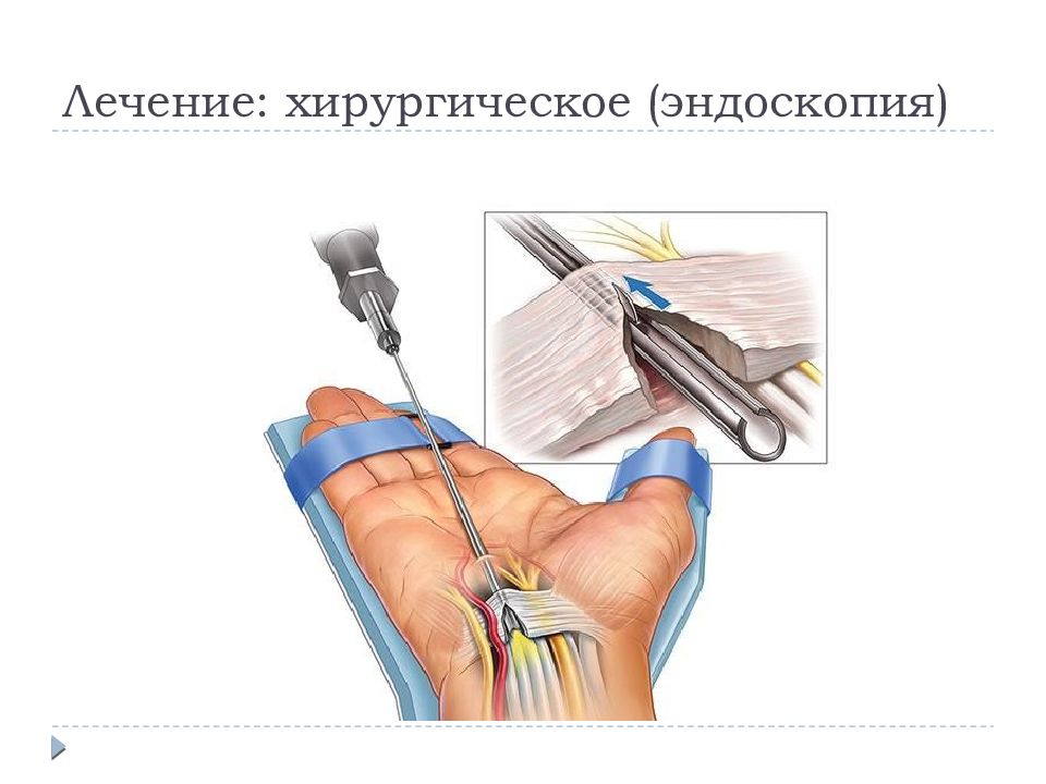 Синдром запястного канала картинки