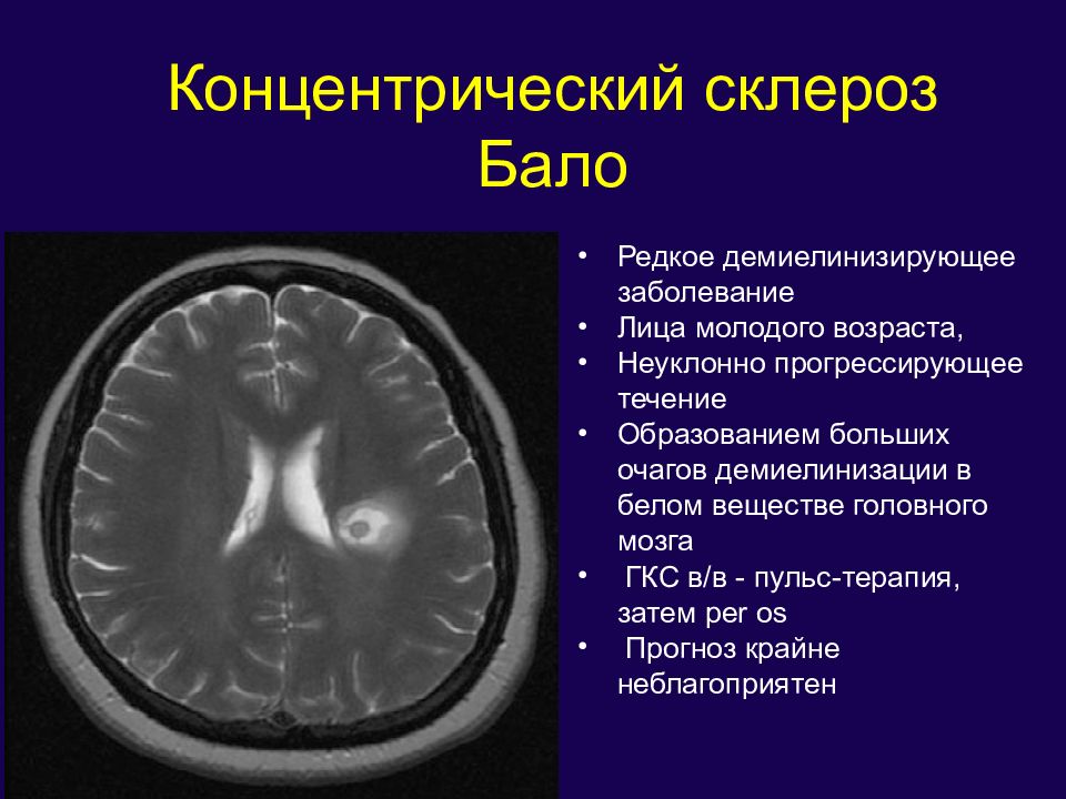 Демиелинизация головного. Очаги демиелинизации головного мозга на мрт. Концентрический склероз балло. Демиелинизирующие заболевания головного мозга. Деминиелизирующий процесс.