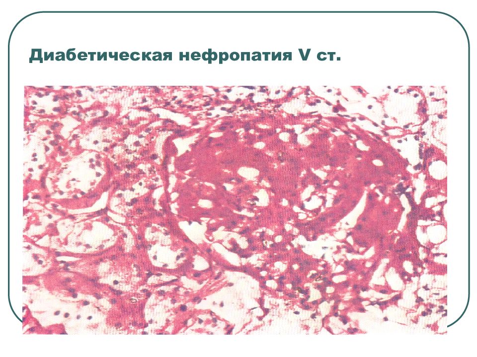 Диабетическая нефропатия мкб. Диабетическая нефропатия микропрепарат. Диабетическая нефропатия микро. Диабетическая нефропатия патанатомия. Диабетическая нефропатия гистология.