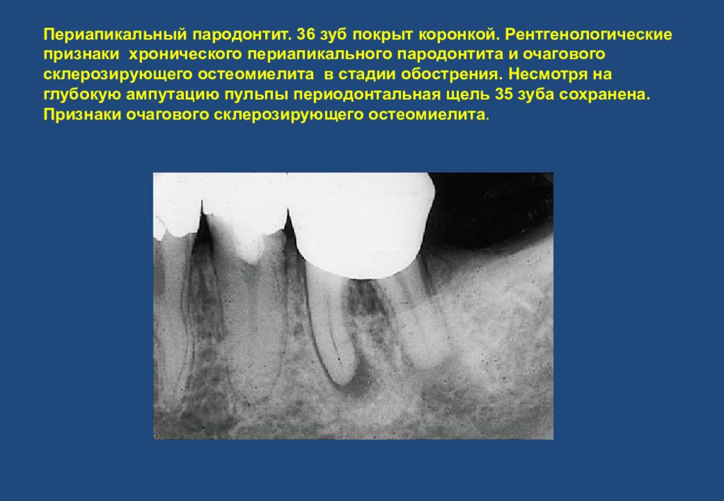 Диагностика пародонта. Рентгенодиагностика остеомиелита челюсти. Периапикальный пародонтит. Склерозирующий остеомиелит челюсти. Очаговый пародонтит рентген.