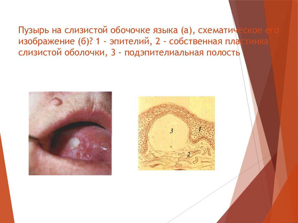 Пузырь на слизистой обочочке языка (а), схематическое его изображение (б)? 1 - эпителий, 2 - собственная пластинка слизистой оболочки, 3 - подэпителиальная