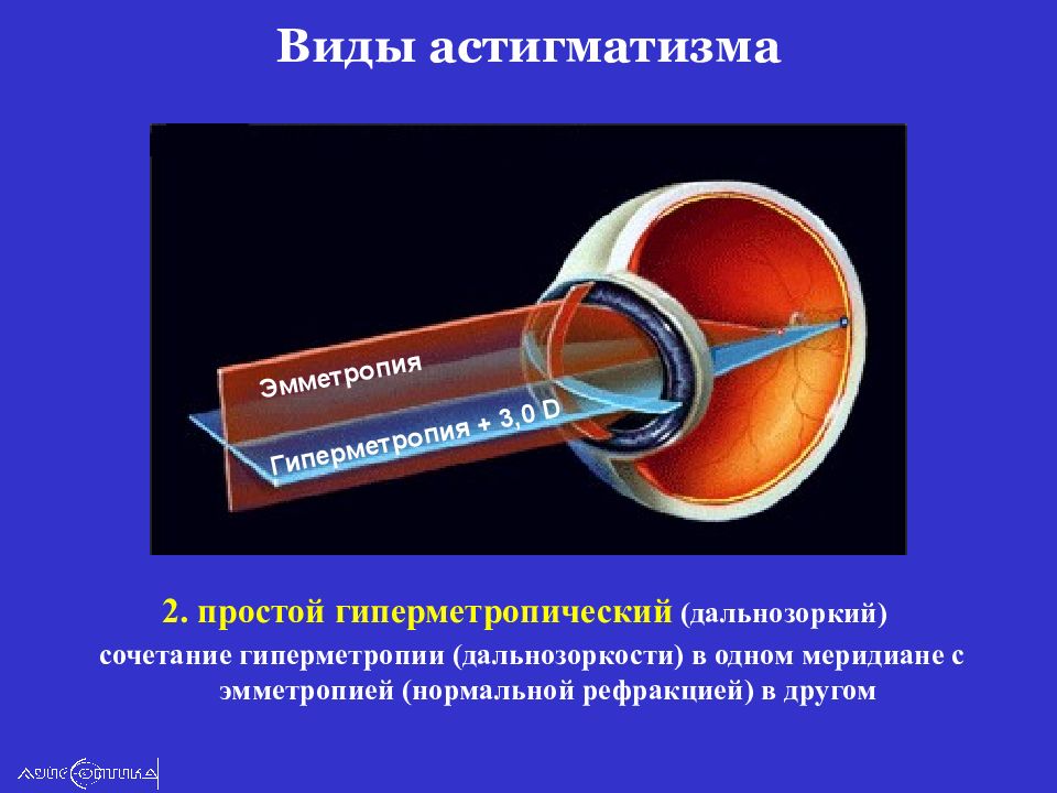 Что такое астигматизм. Эмметропия астигматизм. Неправильный астигматизм. Гиперметропический астигматизм. Простой и сложный астигматизм.