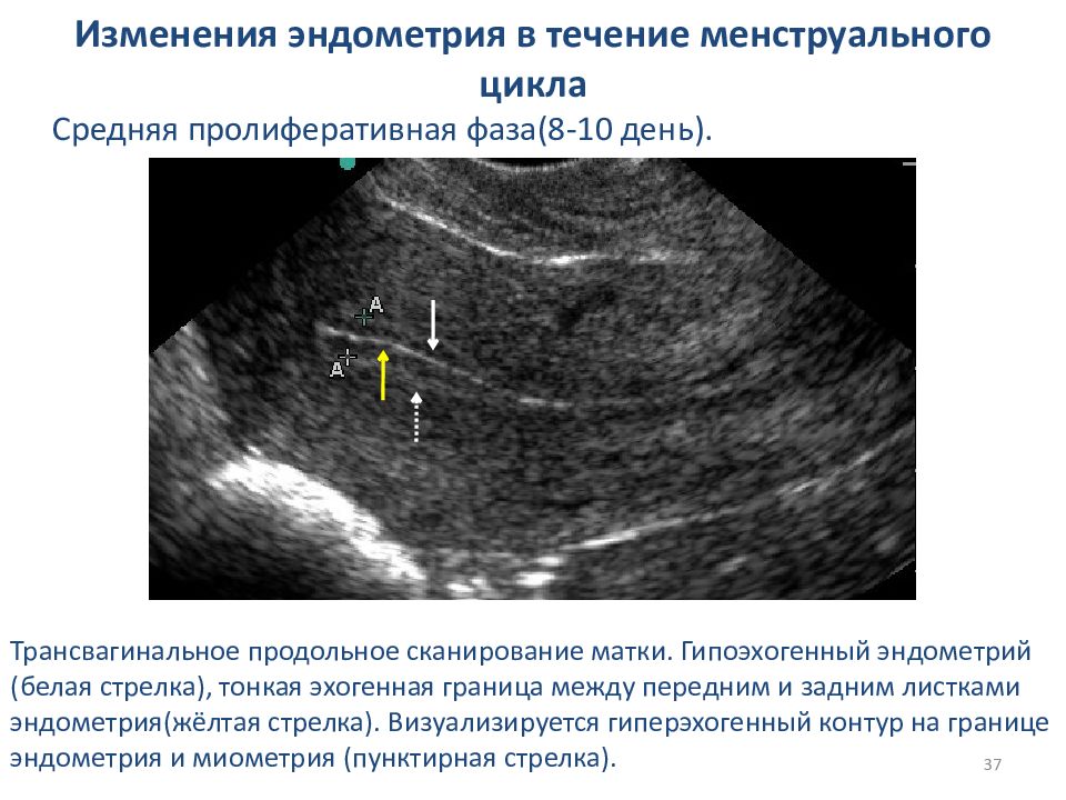 Эндометрия 3 мм. Пролиферативная фаза на УЗИ. Эндометрия пролиферативная фаза УЗИ. Эндометрий фазы цикла эндометрия менструационного. Трехслойный эндометрий на УЗИ.
