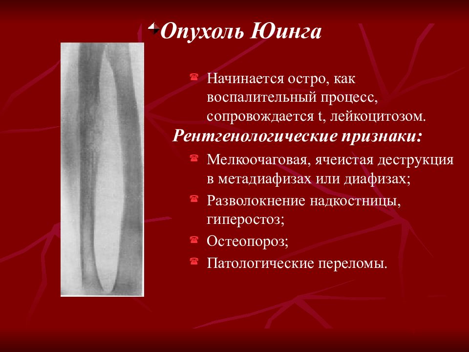 Симптомы рака костей у женщин. Рентгенодиагностика опухолей костей. Саркома Юинга рентгенологические. Опухоль Юинга рентгенодиагностика.