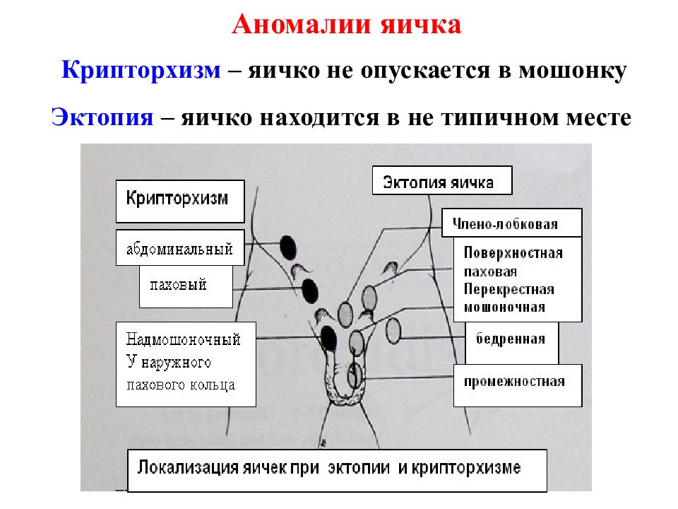 Презентация аномалии яичек