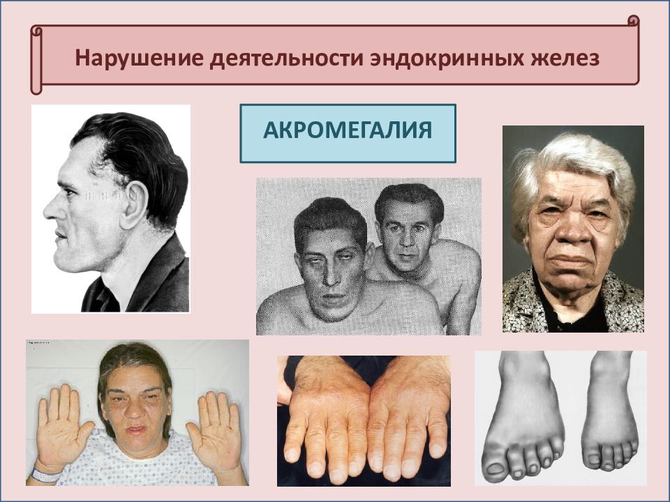 Гипофиз акромегалия гормоны. Гипофиз акромегалия гормоны. Клинические проявления акромегалии. Акромегалия какая железа. Акромегалия эндокринное заболевание.