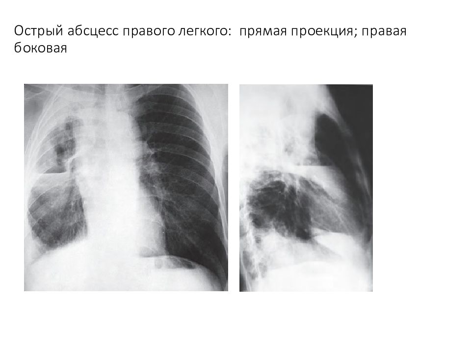 Абсцесс легкого презентация. Абсцесс правого легкого. Острый абсцесс легкого. Нагноительные заболевания легких.