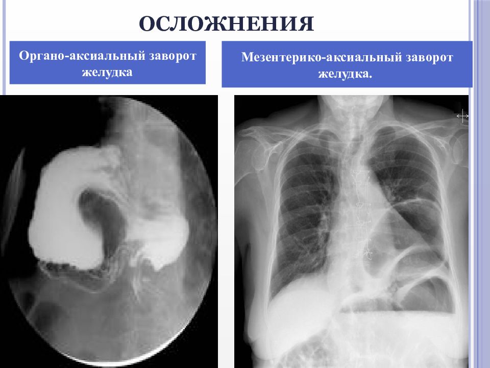 Грыжи пищеводного отверстия диафрагмы презентация по хирургии