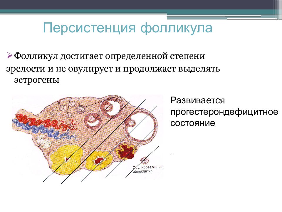 Что такое фолликулы. Персистирующий преовуляторный фолликул. Персистирующий фолликул яичника УЗИ. Персистенция фолликула. Персистирующие желтое тело в яичнике.