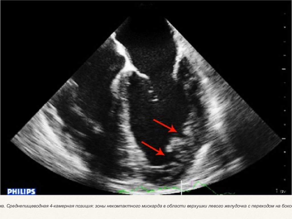 Узи левого. Некомпактный миокард ЭХОКГ. Некомпактный миокард левого желудочка ЭХОКГ. Некомпактный миокард лж. Некомпактный губчатый миокард.