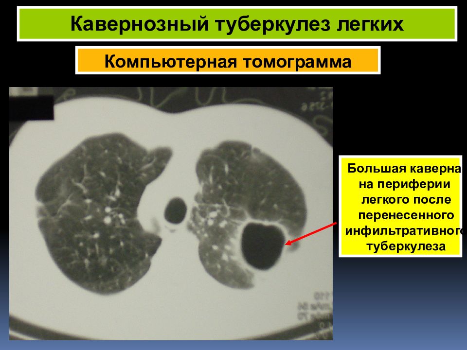 Каверна при туберкулезе. Кавернозный туберкулез легких кт. Диссеминированный кавернозный туберкулез кт. Фиброзно-кавернозный туберкулез легких кт. Каверна туберкулёз НАИКТ.