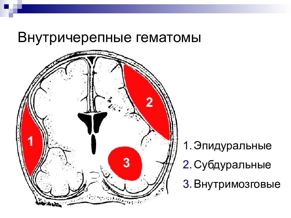 Гематома головного мозга рассасывается. Внутричерепная тератома. Внутричерепная гематома. Гематомы эпидуральные субдуральные внутримозговые. Внутричерепные гематомы классификация.