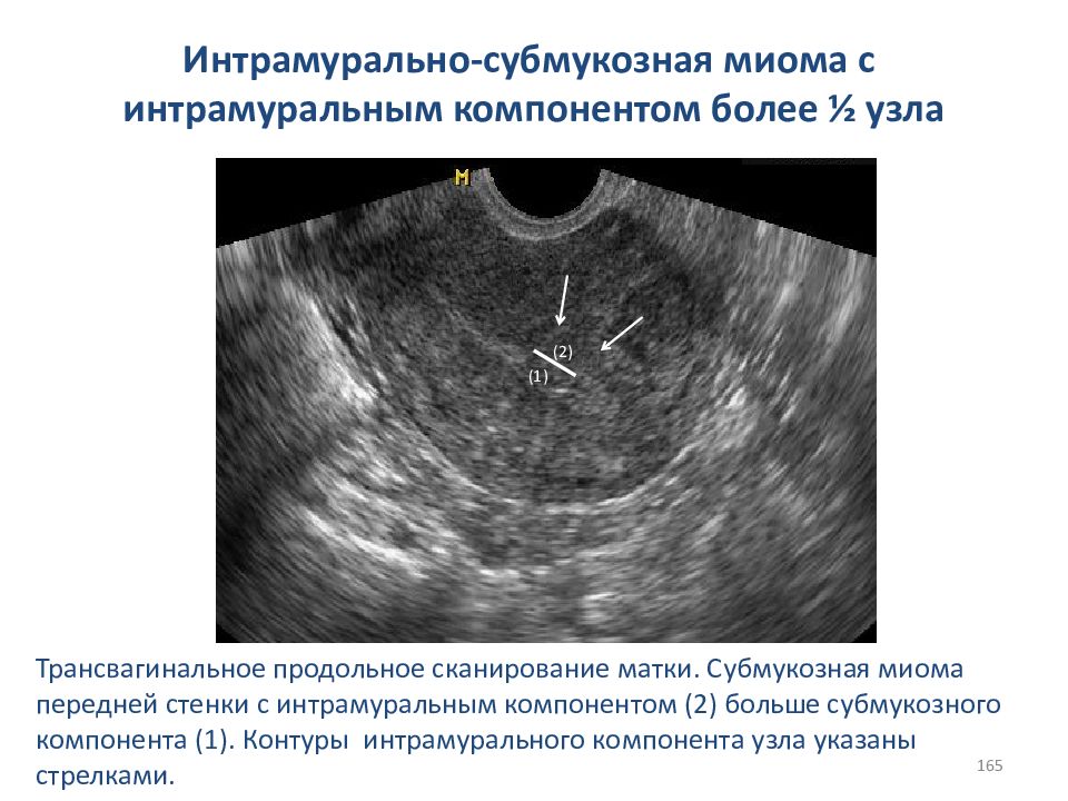 Матка 12 мм. Миомэктомия матки миомэктомия. Множественная миома матки УЗИ. УЗИ критерии миомы матки.