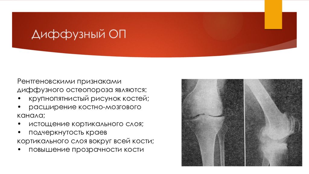 Признаки диффузных. Диффузионный остеопороз что. Диффузный остеопороз костей. Остеопороз рентген признаки.