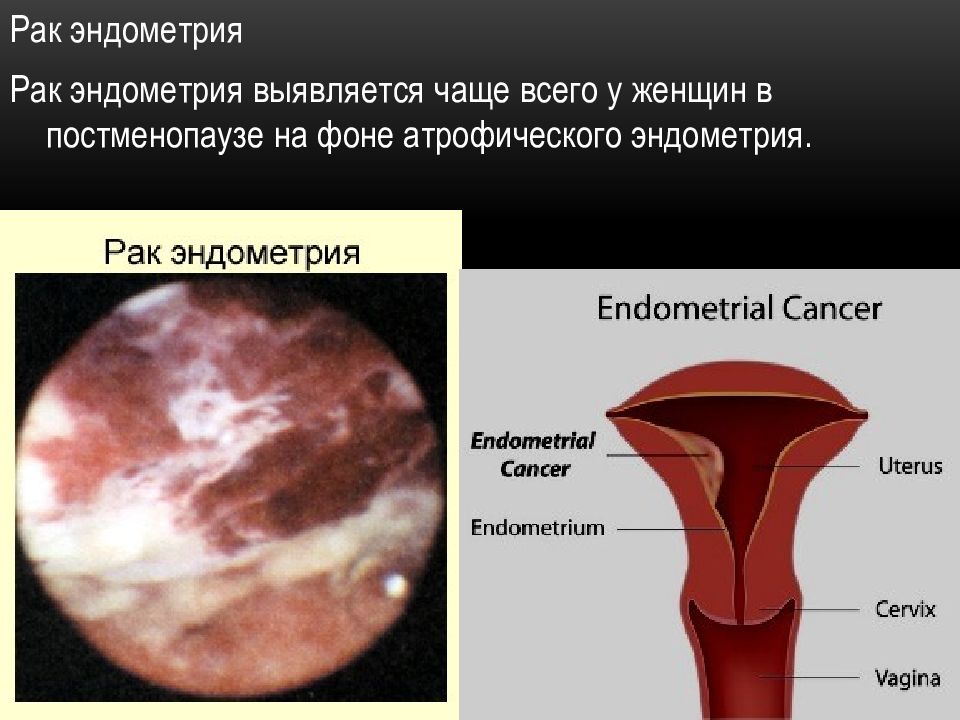 Полип эндометрия картинки