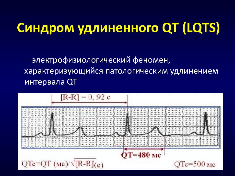 Удлиненное qt у ребенка. Синдром удлиненного интервала qt на ЭКГ. Удлиненный интервал qt на ЭКГ что это такое. Феномен удлиненного qt на ЭКГ. ЭКГ С синдромом удлиненного интервала qt у детей.