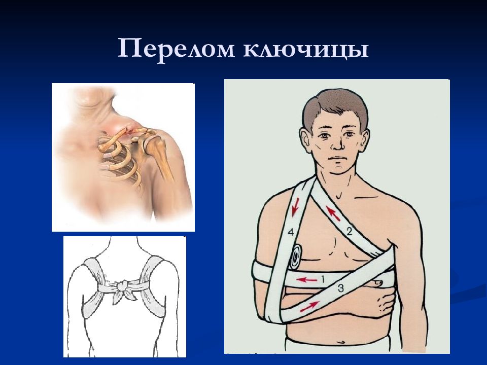 Оказание первой помощи при переломе ключицы. ПМП при переломе ключицы. Перелом ключицы первая помощь. Перелом ключицы первая медицинская помощь. ПМП перелома ключичитцы.