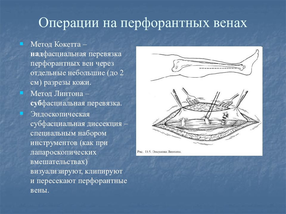 Перфорантных вен. Надфасциальная перевязка перфорантных вен. Операции на перфорантные вены. Эндоскопическая диссекция перфорантных вен.