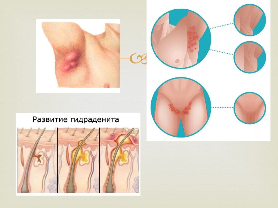 Жұмсақ тіндердің іріңді процес стері. Suppurative processes of soft tissues