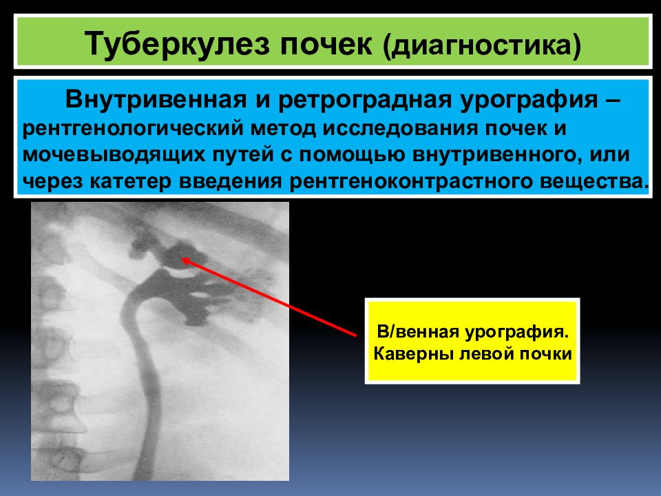 Туберкулез почек и мочевыводящих путей презентация