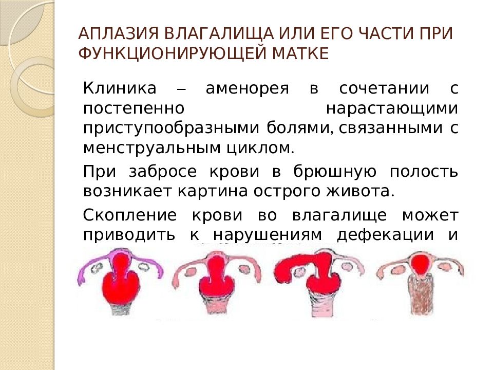 Аномалии женских половых органов презентация