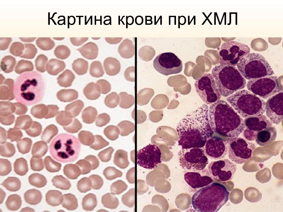 Картина крови при хроническом миелолейкозе