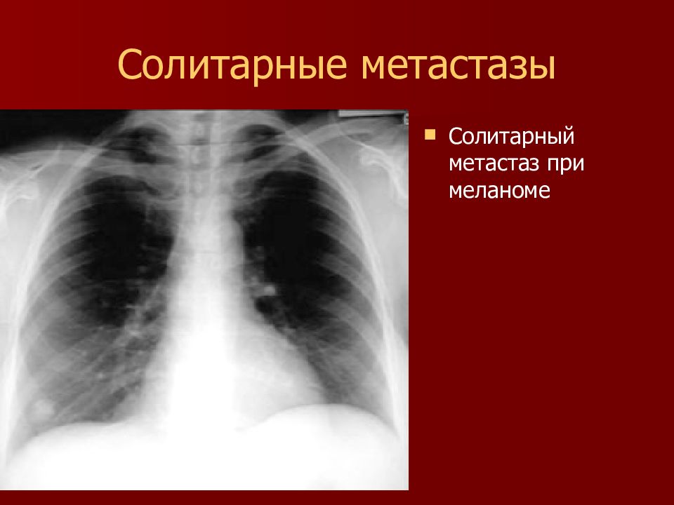 Меланома в легких. Солитарный метастаз в легком. Метастазы в легких рентген. Солитарный костные метастазы.