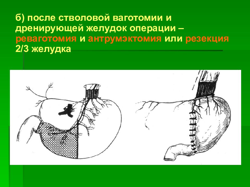 После операции на желудок. Стволовая ваготомия с антрумэктомией. Стволовая ваготомия с антрумэктомией ход операции. Стволовая ваготомия с экономной резекцией желудка. Резекция желудка и ваготомия.