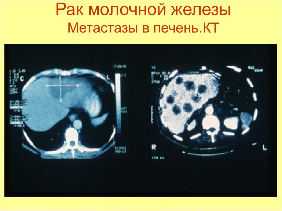 Метастазирование рака молочной железы схема