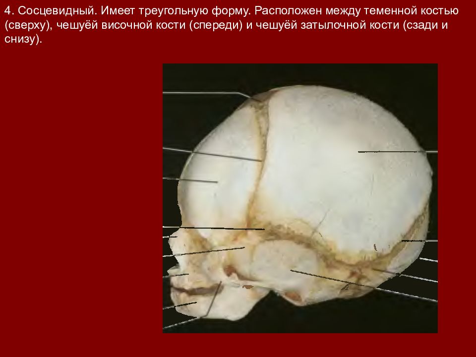 Перелом теменной кости у грудного. Между лобной и теменными костями. Перелом теменной кости у новорожденного. Чешуя лобной кости. Чешуя затылочной кости.