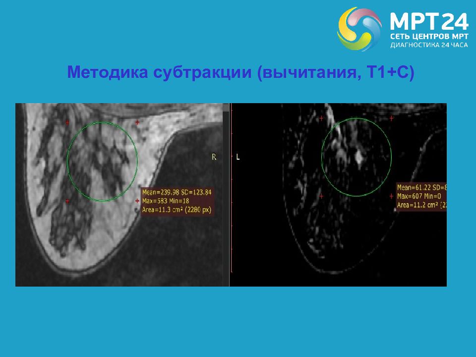 Доброкачественная дисплазия молочных желез клиническая рекомендация. Доброкачественная дисплазия молочной. Этиология ДДМЖ.