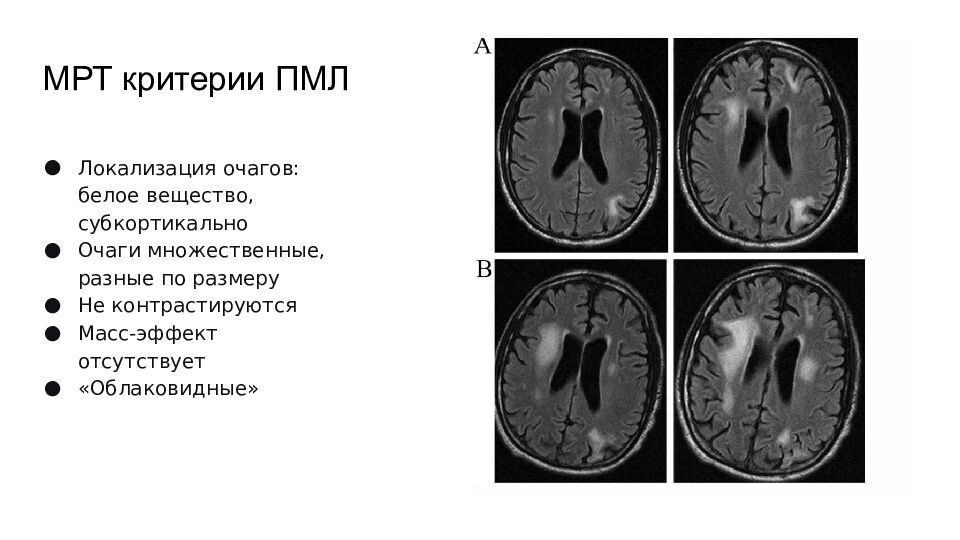 МРТ критерии ПМЛ