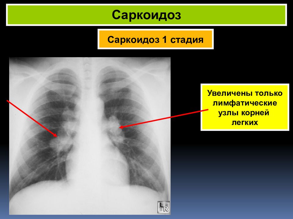 Узлы в легких что это. Саркоидоз рентген 4 стадия. Саркоидоз 2 стадии рентген. Саркоидоз внутригрудных лимфатических узлов рентген.