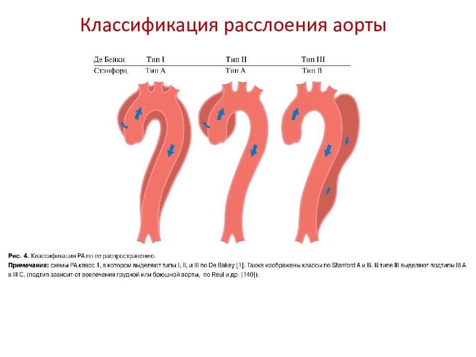 Расслаивающаяся аорта. Типы расслоения аорты. Расслоение аорты клиника.