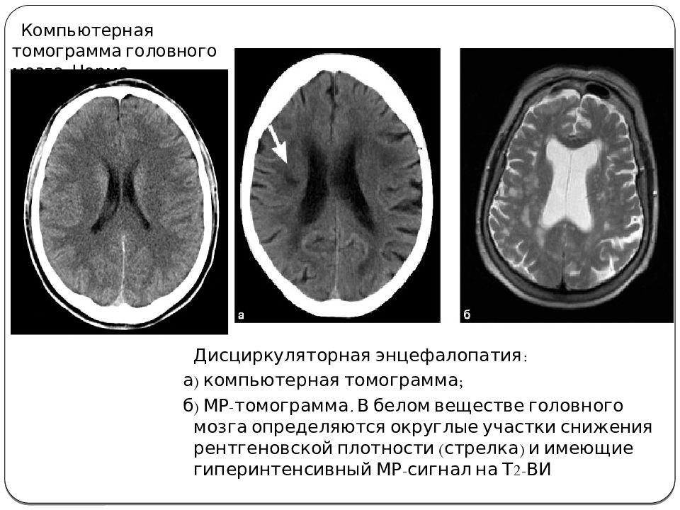 Мр картина очаговых изменений. Дисциркуляторная энцефалопатия презентация. Дисциркуляторная энцефалопатия головного мозга. МР картина дисциркуляторной энцефалопатии что это. Изменения дисциркуляторного характера в головном мозге.