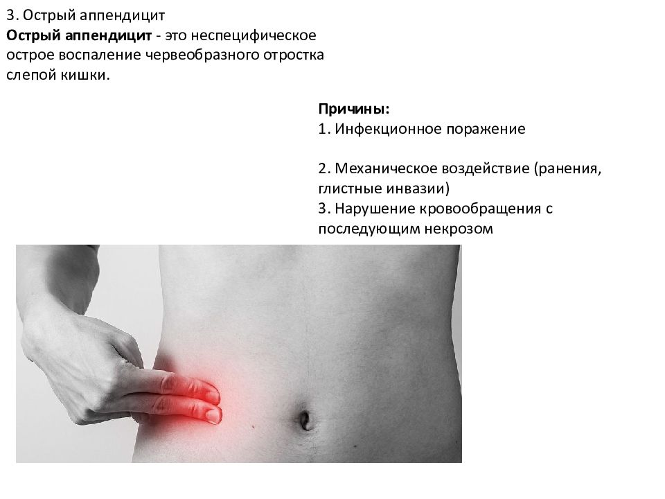 Аппендицит находится. Воспаление аппендицита симптомы. Локализация боли при аппендиците. Расположение аппендицита. Болит аппендицит симптомы.