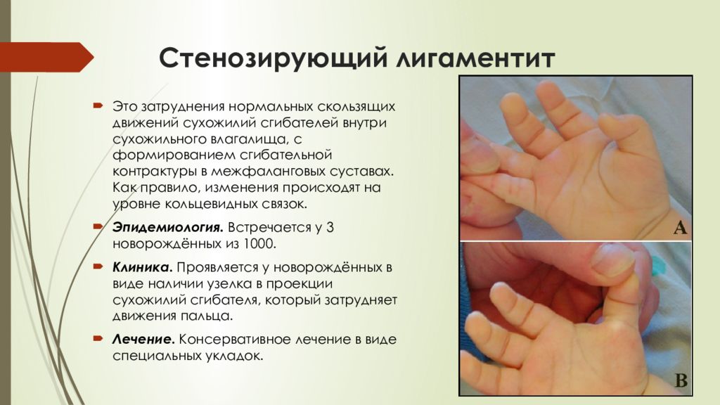 Болит и щелкает большой палец на руке. Стенозирующий лигаментит. Стенозирующий лигаментит пальца. Лигаментит пальца кисти. Болезнь Нотта большого пальца.