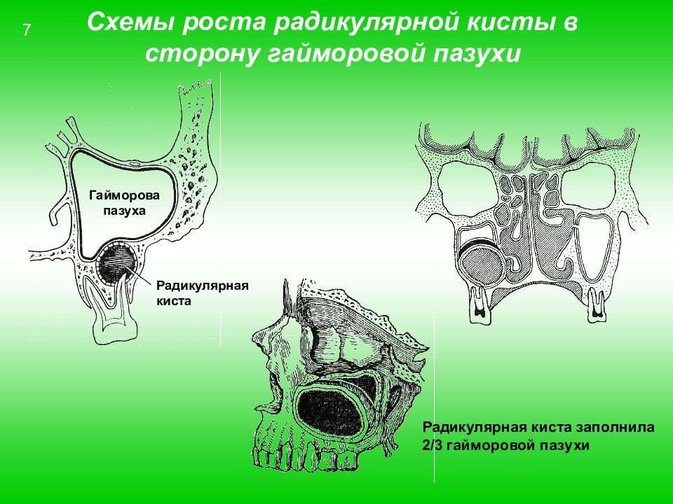 Верхнечелюстной синусит презентация