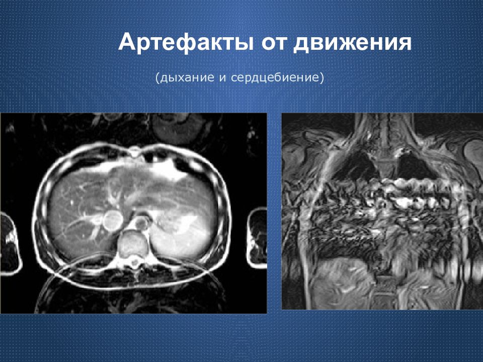 Артефакты кт изображений