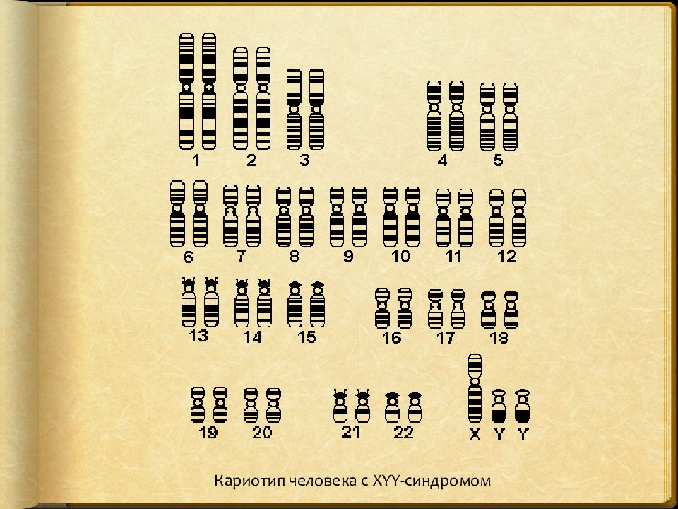 Кариотип человека. Кариотип человека таблица. XYY кариотип кариотип синдром. Кариотип человека с XYY синдром.