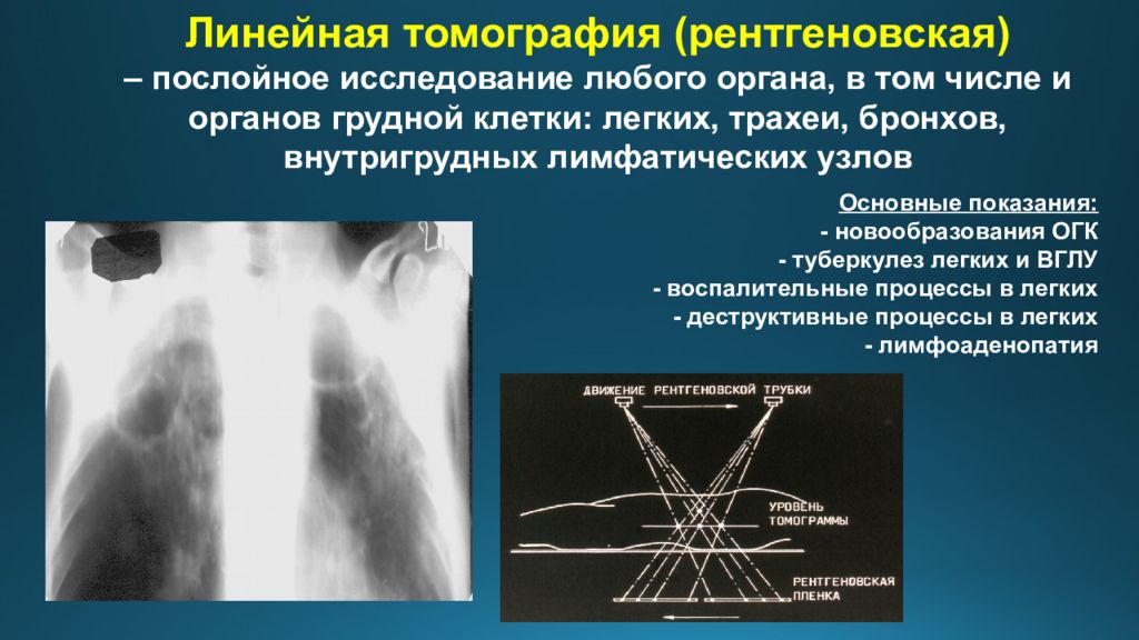 Лучевые линейные. Методы рентгенологического исследования органов грудной клетки. Лучевые методы исследования органов грудной клетки. Линейная томография принцип метода. Линейная томограмма органов грудной клетки.